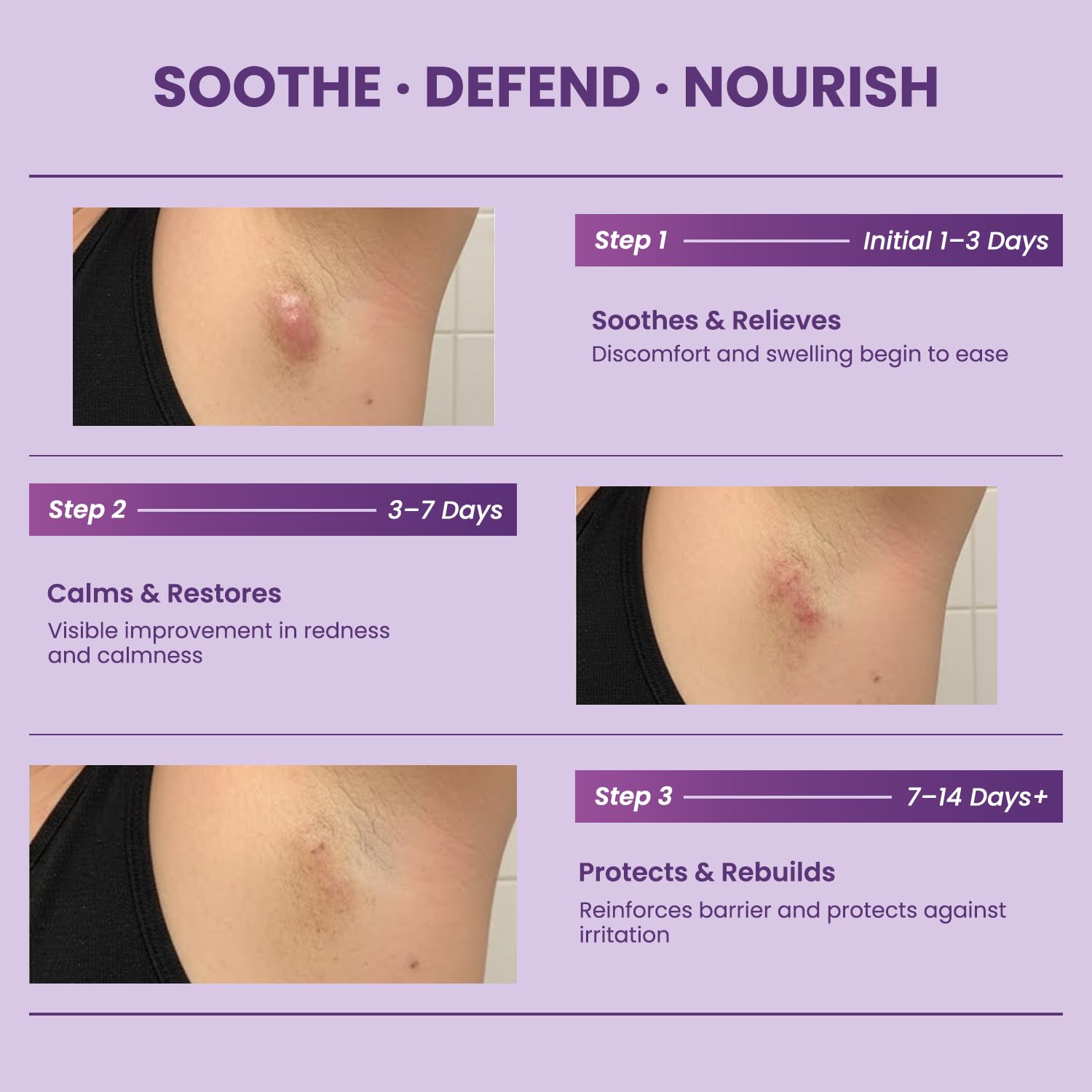 Hidradenitis Suppurativa Flare Defense Balm for Bump-Prone Skin - Daily Protection with Microsilver BG & Zinc Oxide - Non-Greasy (2oz)